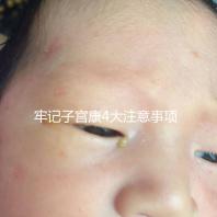 牢記子宮康4大注意事項,輕松避免胃脹、腹瀉等副作用