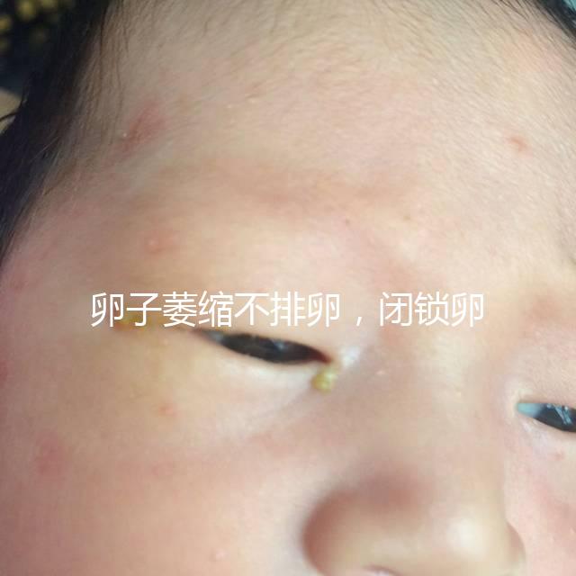 卵子萎縮不排卵,閉鎖卵泡形成原因與這4點有關(guān)