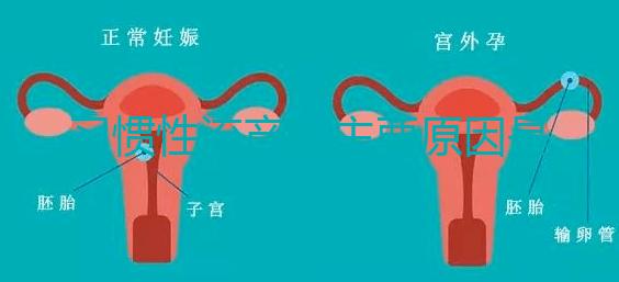 習慣性流產的主要原因是什么？