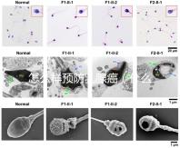 怎么樣預(yù)防乳腺癌(什么人容易得乳腺癌)