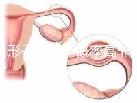 弓形子宮流產(chǎn)概率高非個例！罪魁禍首是這個原因