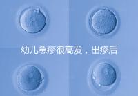 幼兒急疹很高發，出疹后的護理方法及注意事項提前知曉！