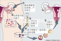 試管嬰兒取卵時疼嗎(試管嬰兒取卵時疼嗎,取卵多長時間才是移植)